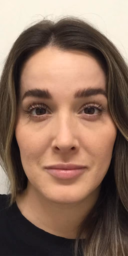 Botox before and after, case 27092 - Cool Springs Plastic Surgery