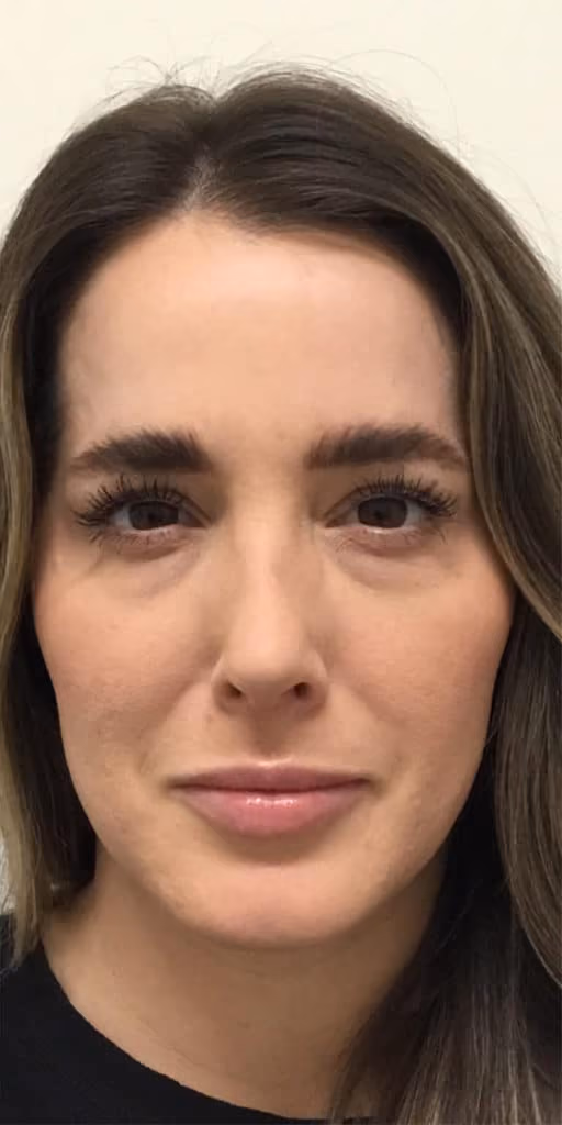Botox before and after, case 27092 - Cool Springs Plastic Surgery
