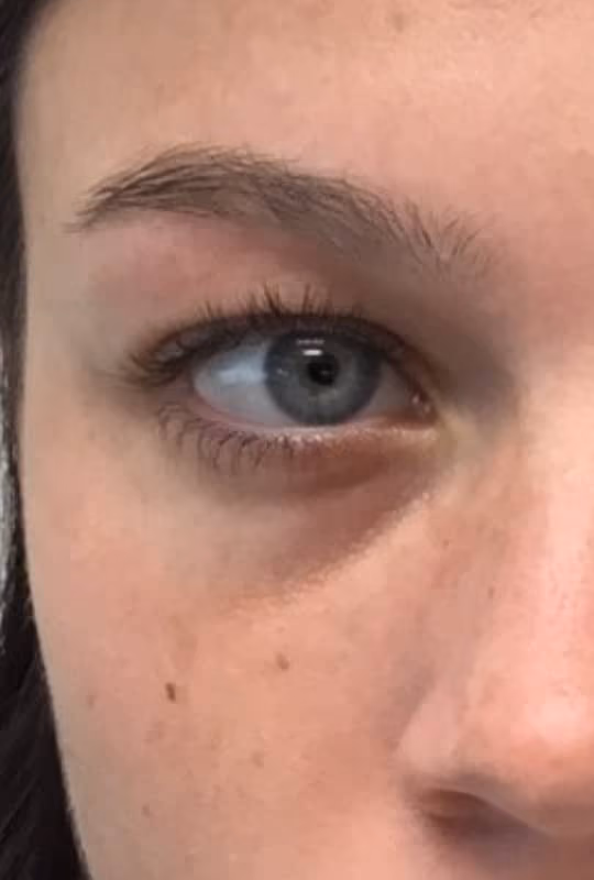 Botox before and after, Chrissy Handly, case 27523 - Cool Springs Plastic Surgery