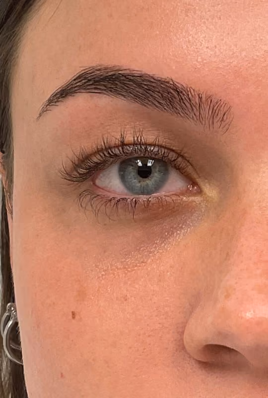 Botox before and after, Chrissy Handly, case 27523 - Cool Springs Plastic Surgery