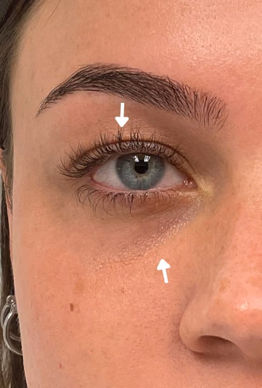 Botox before and after, Chrissy Handly, case 27523 - Cool Springs Plastic Surgery