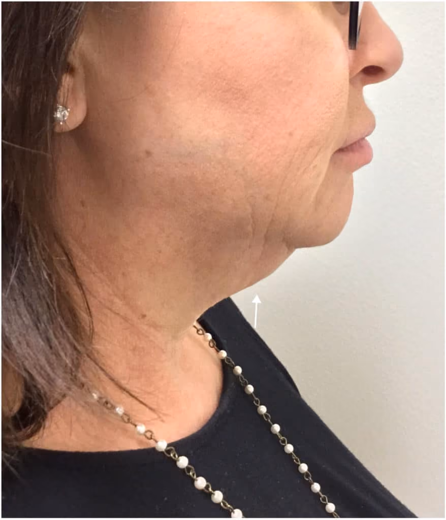 Kybella before and after, Olivia Salmen, case 11745 - Cool Springs Plastic Surgery
