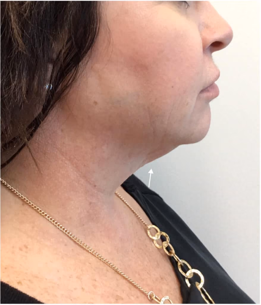 Kybella before and after, Olivia Salmen, case 11745 - Cool Springs Plastic Surgery