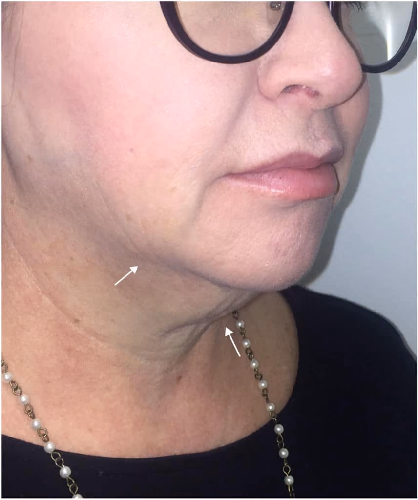 Kybella before and after, Olivia Salmen, case 11745 - Cool Springs Plastic Surgery