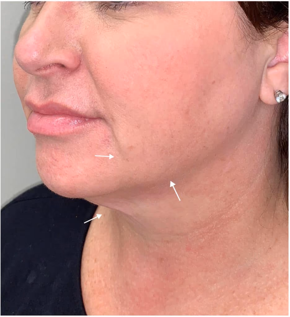 Kybella before and after, Olivia Salmen, case 11745 - Cool Springs Plastic Surgery