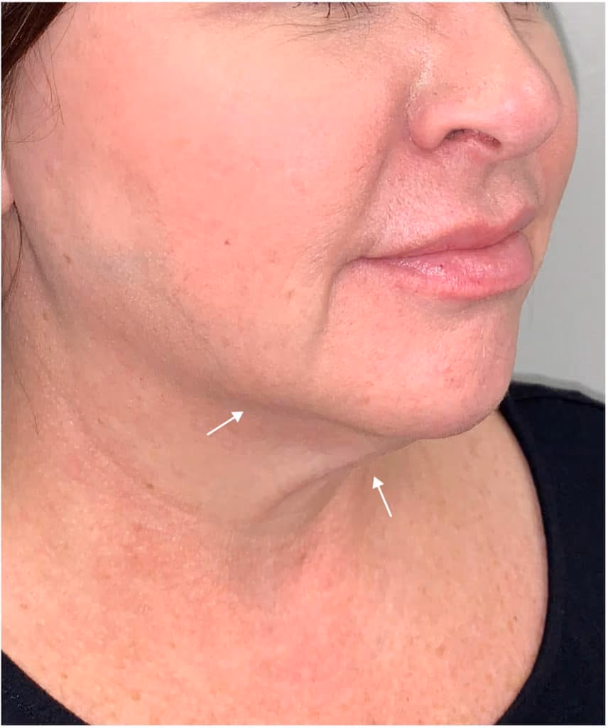 Kybella before and after, Olivia Salmen, case 11745 - Cool Springs Plastic Surgery