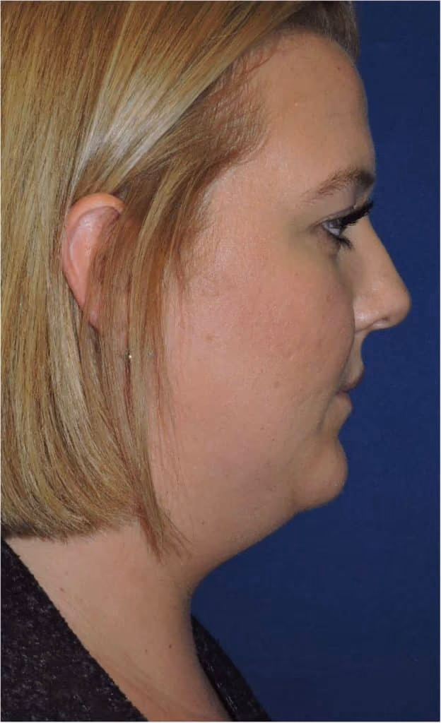 Kybella before and after, Olivia Salmen, case 12003 - Cool Springs Plastic Surgery