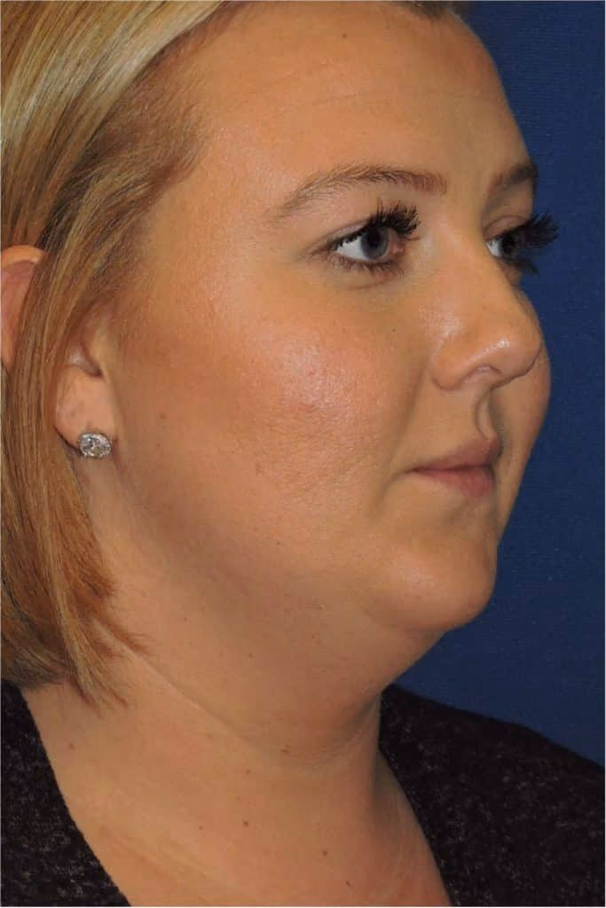 Kybella before and after, Olivia Salmen, case 12003 - Cool Springs Plastic Surgery