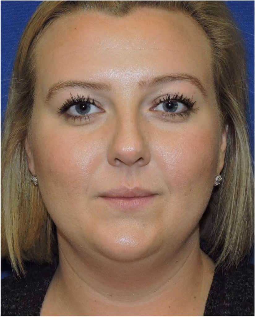 Kybella before and after, Olivia Salmen, case 12003 - Cool Springs Plastic Surgery