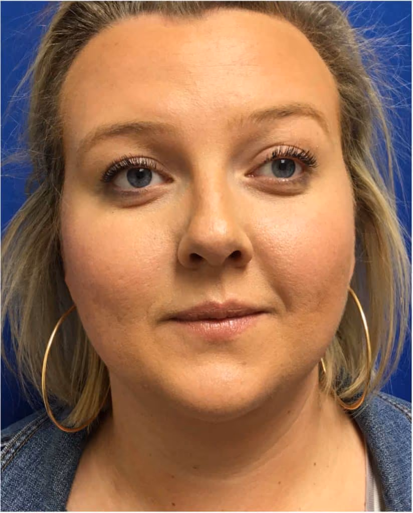 Kybella before and after, Olivia Salmen, case 12003 - Cool Springs Plastic Surgery