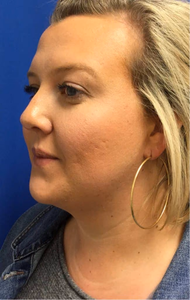 Kybella before and after, Olivia Salmen, case 12003 - Cool Springs Plastic Surgery