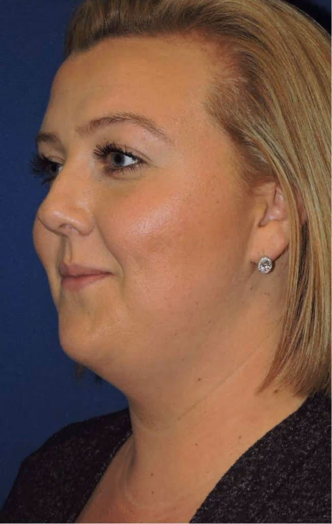Kybella before and after, Olivia Salmen, case 12003 - Cool Springs Plastic Surgery