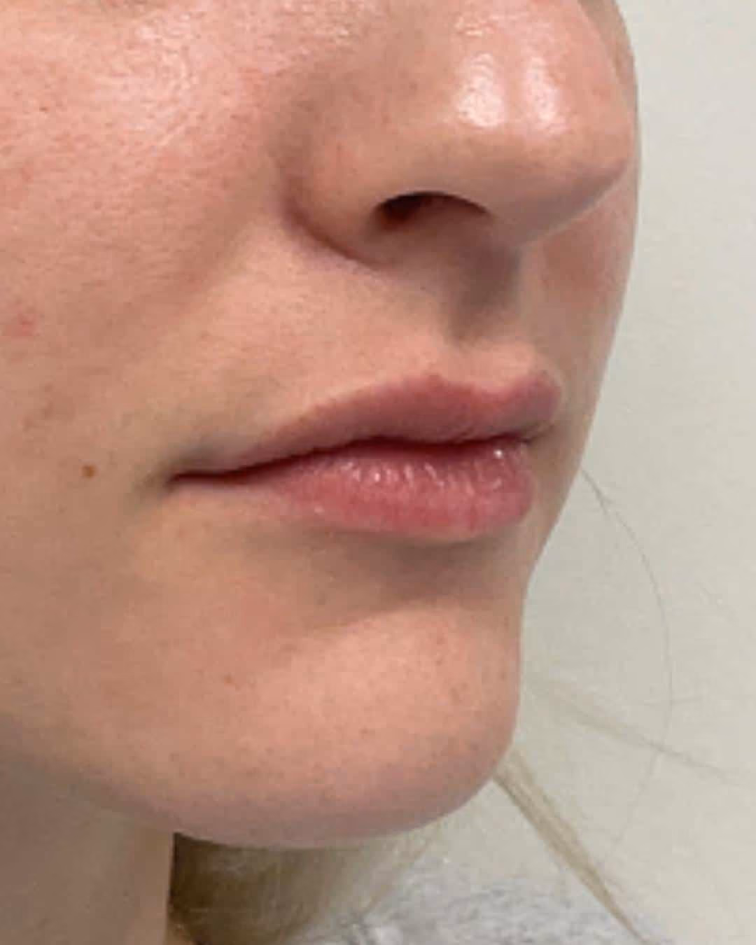 Kybella before and after, Chrissy Handly, case 12315 - Cool Springs Plastic Surgery