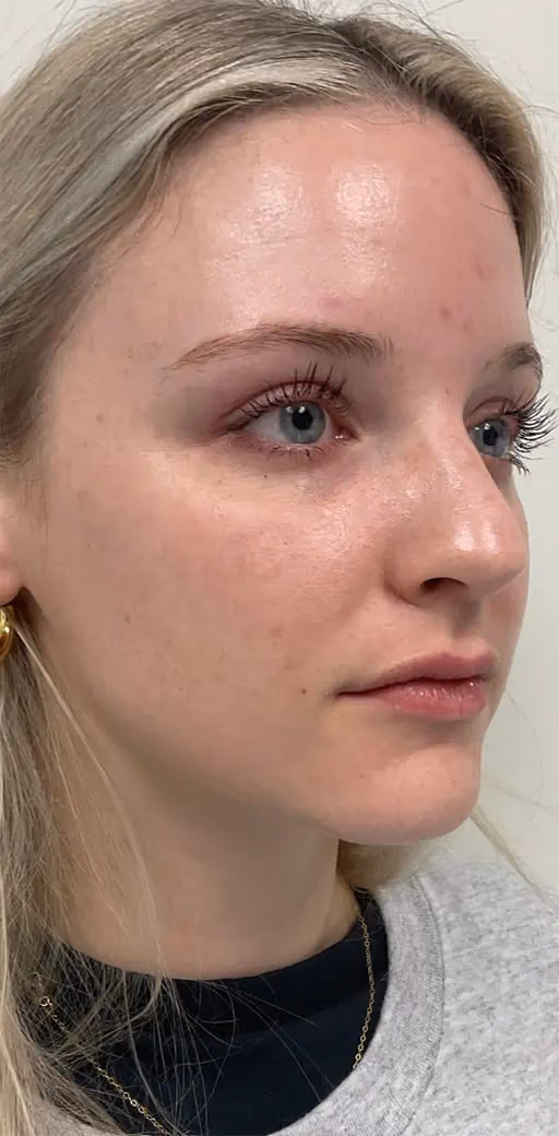 Kybella before and after, Chrissy Handly, case 12315 - Cool Springs Plastic Surgery