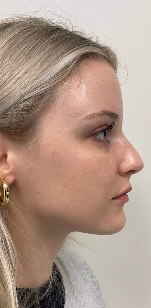 Kybella before and after, Chrissy Handly, case 12315 - Cool Springs Plastic Surgery