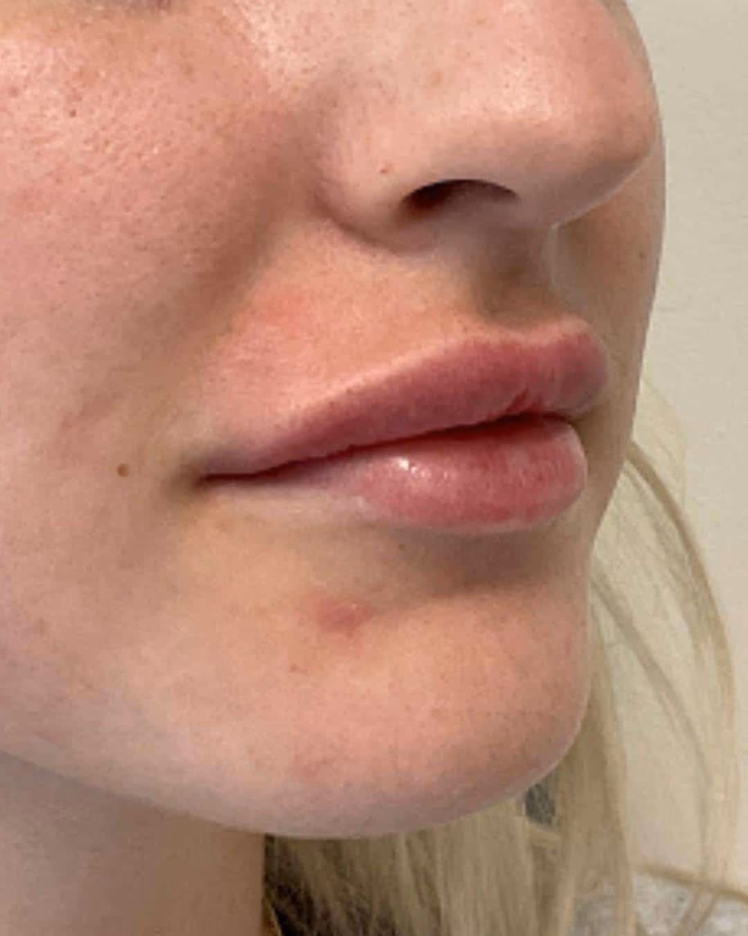 Kybella before and after, Chrissy Handly, case 12315 - Cool Springs Plastic Surgery