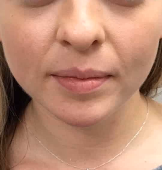 Kybella before and after, Olivia Salmen, case 17349 - Cool Springs Plastic Surgery
