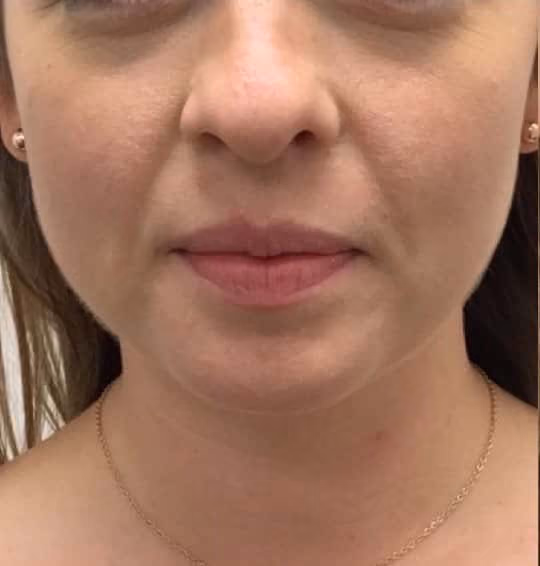 Kybella before and after, Olivia Salmen, case 17349 - Cool Springs Plastic Surgery