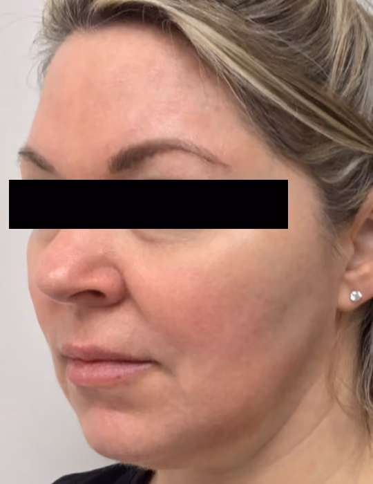 Kybella before and after, Chrissy Handly, case 18619 - Cool Springs Plastic Surgery