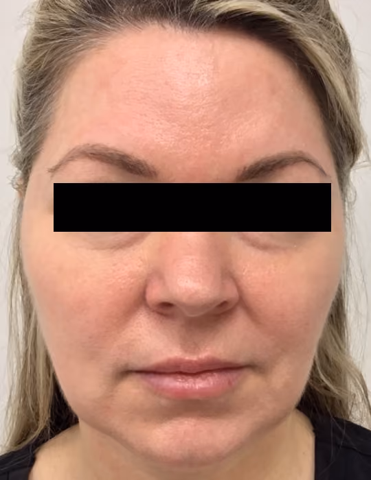 Kybella before and after, Chrissy Handly, case 18619 - Cool Springs Plastic Surgery