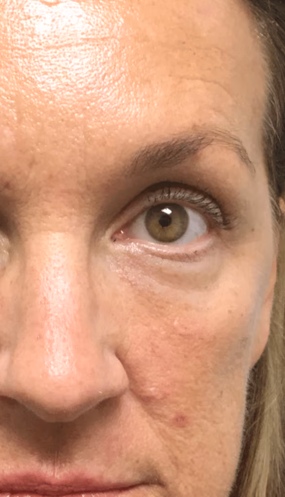 Botox before and after, Olivia Salmen, case 9568 - Cool Springs Plastic Surgery