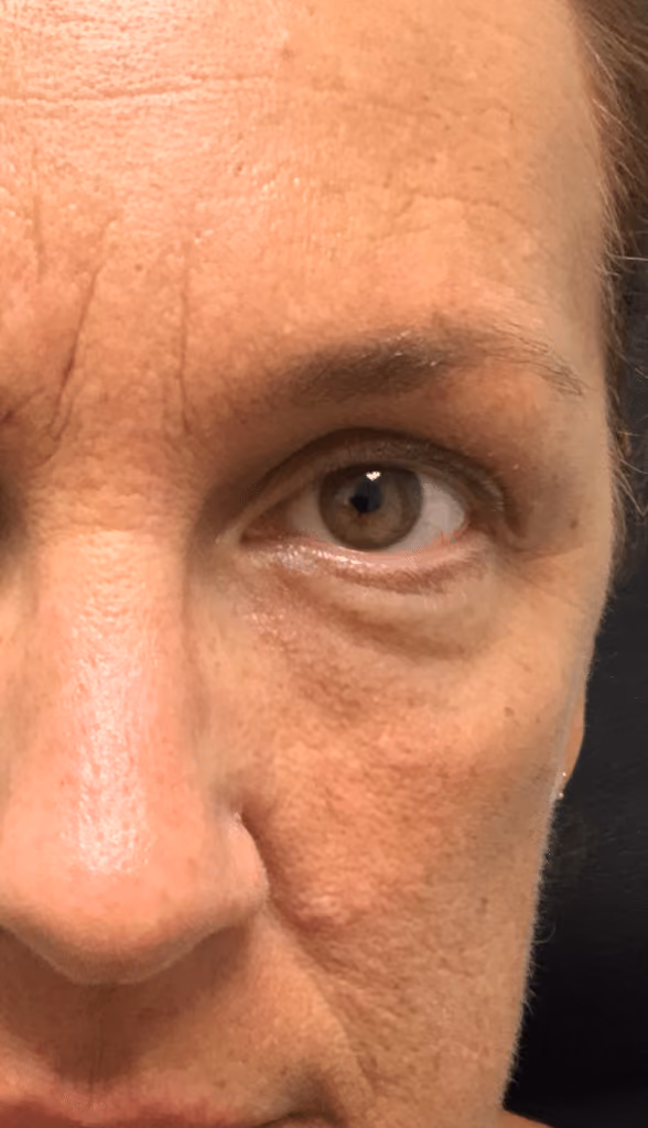 Botox before and after, Olivia Salmen, case 9568 - Cool Springs Plastic Surgery