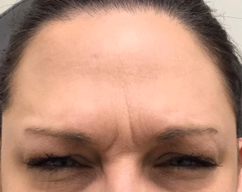 Botox before and after, case 14242 - Cool Springs Plastic Surgery