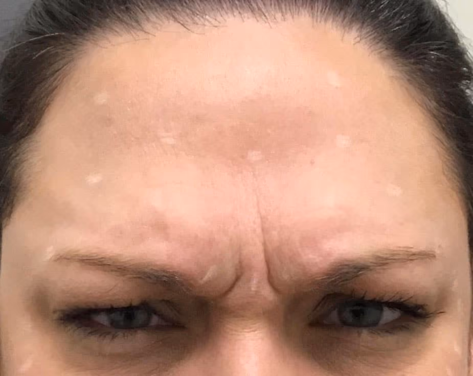 Botox before and after, case 14242 - Cool Springs Plastic Surgery