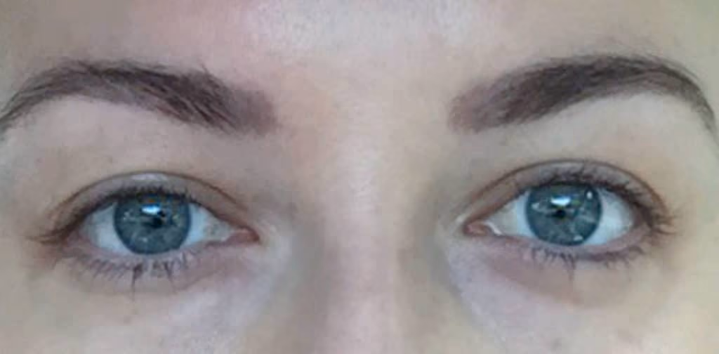 Botox before and after, case 14262 - Cool Springs Plastic Surgery