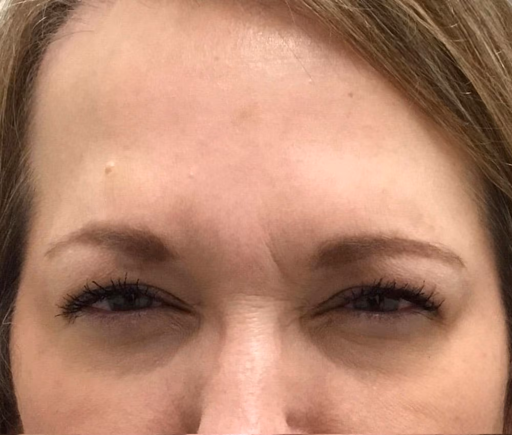 Botox before and after, case 14344 - Cool Springs Plastic Surgery