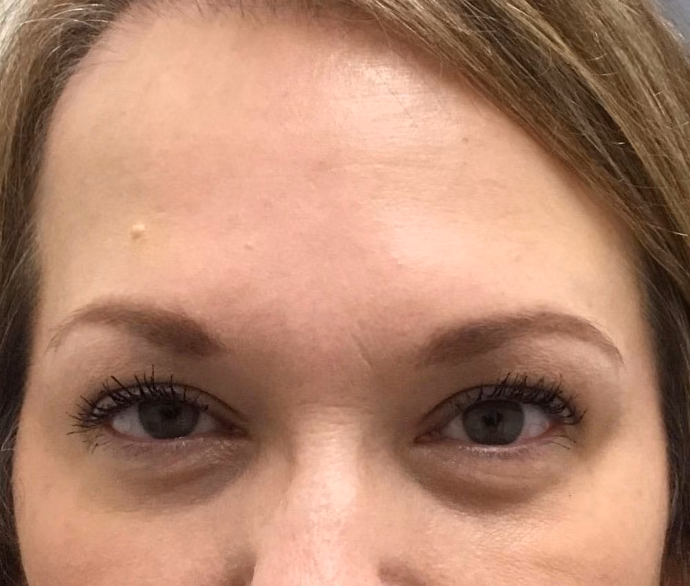 Botox before and after, case 14344 - Cool Springs Plastic Surgery