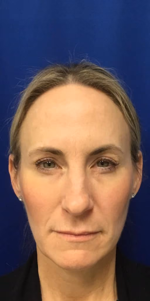 Botox before and after, case 14541 - Cool Springs Plastic Surgery