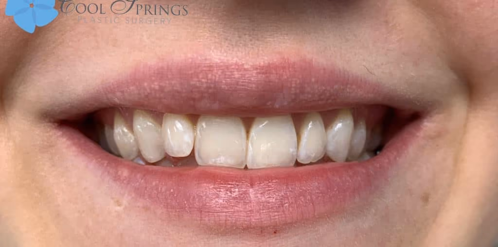 Botox before and after, case 14647 - Cool Springs Plastic Surgery