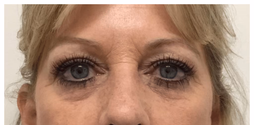 Botox before and after, Michele Bailey, case 15885 - Cool Springs Plastic Surgery