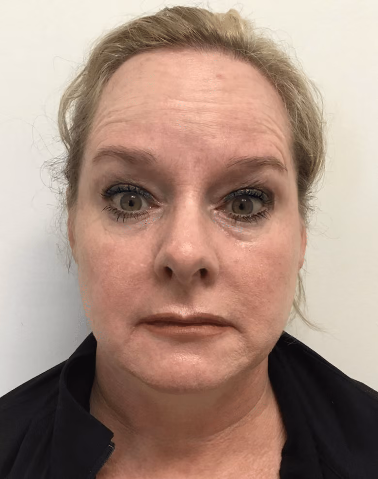 Botox before and after, case 15915 - Cool Springs Plastic Surgery