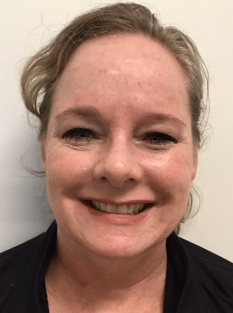 Botox before and after, case 15915 - Cool Springs Plastic Surgery