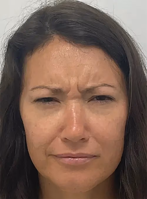 Botox before and after, case 15925 - Cool Springs Plastic Surgery