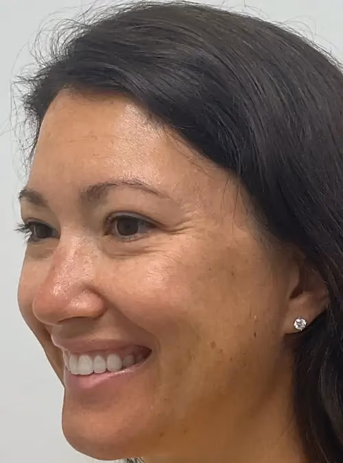 Botox before and after, case 15925 - Cool Springs Plastic Surgery