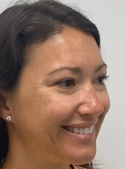 Botox before and after, case 15925 - Cool Springs Plastic Surgery