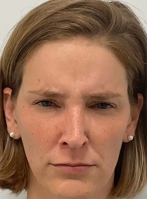 Botox before and after, case 15926 - Cool Springs Plastic Surgery
