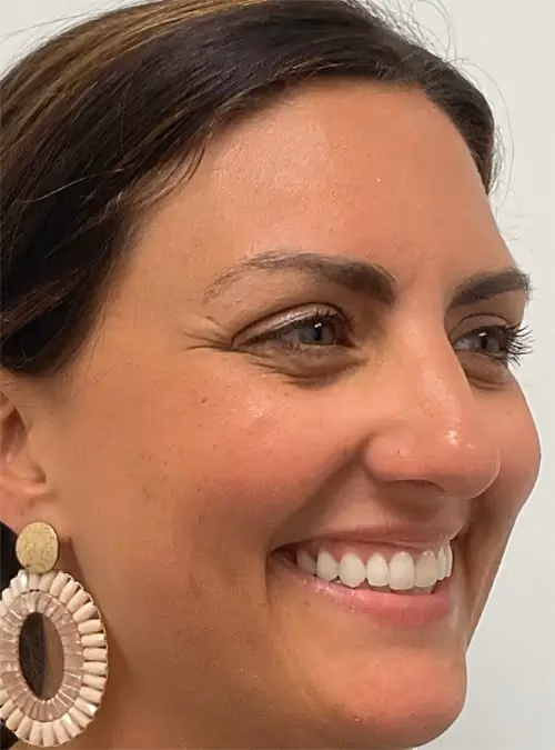 Botox before and after, case 15927 - Cool Springs Plastic Surgery