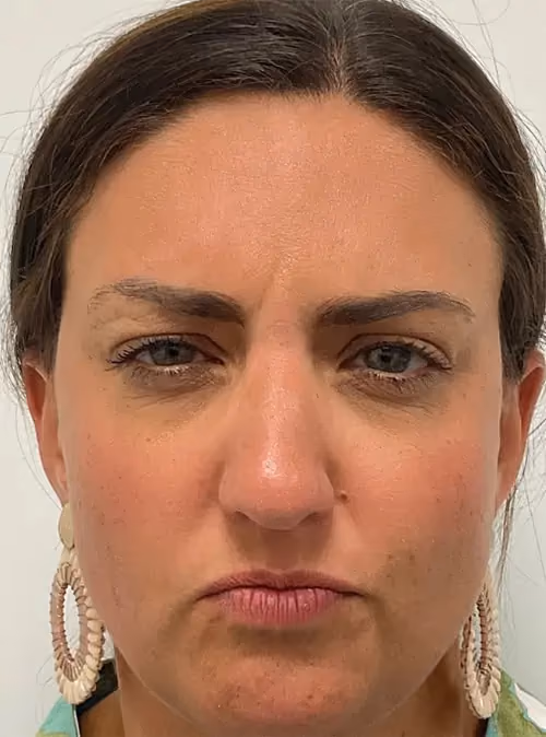 Botox before and after, case 15927 - Cool Springs Plastic Surgery