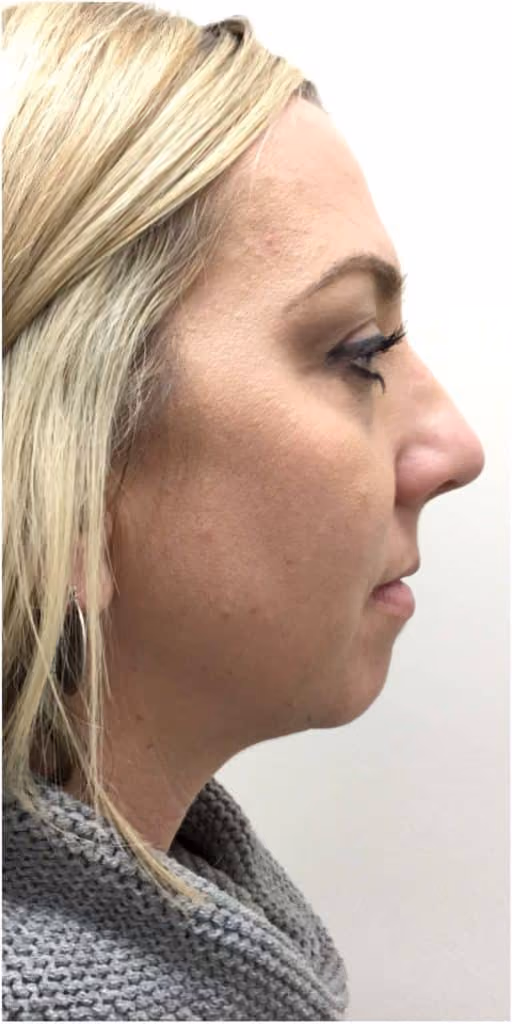 Kybella before and after, Olivia Salmen, case 11957 - Cool Springs Plastic Surgery