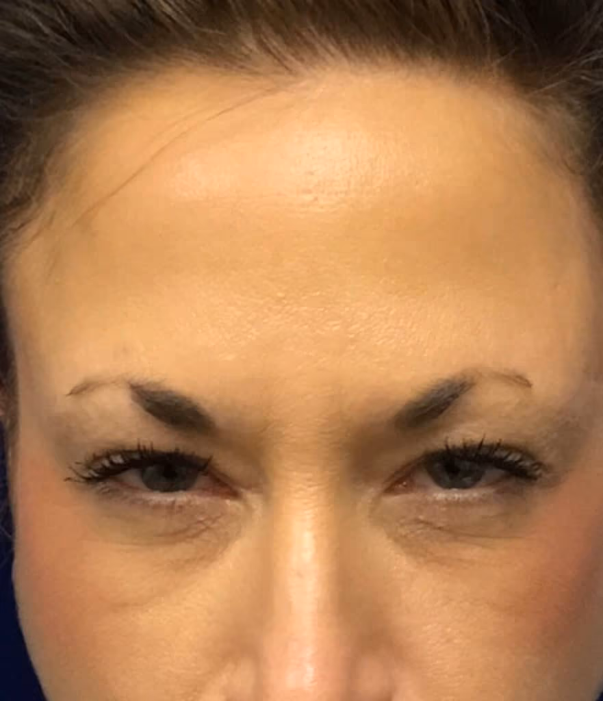 Botox before and after, case 15937 - Cool Springs Plastic Surgery