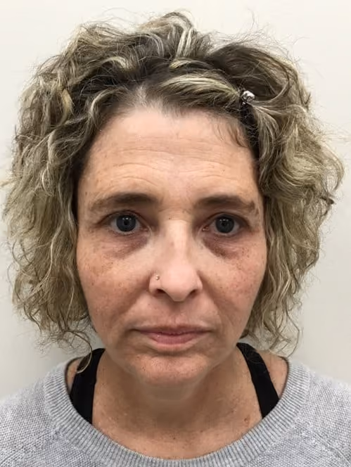 BBL before and after, case 13021 - Cool Springs Plastic Surgery