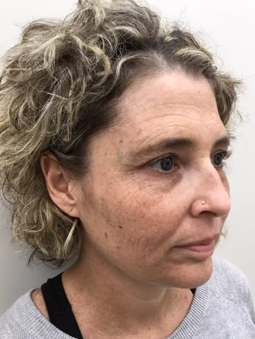 BBL before and after, case 13021 - Cool Springs Plastic Surgery