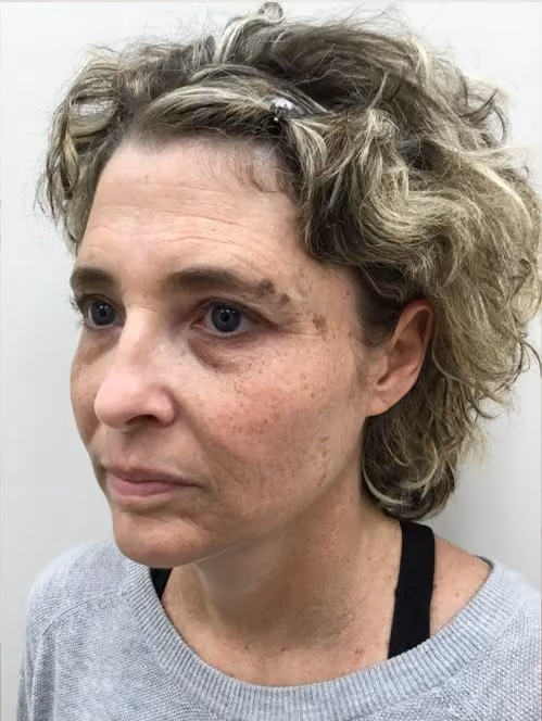 BBL before and after, case 13021 - Cool Springs Plastic Surgery