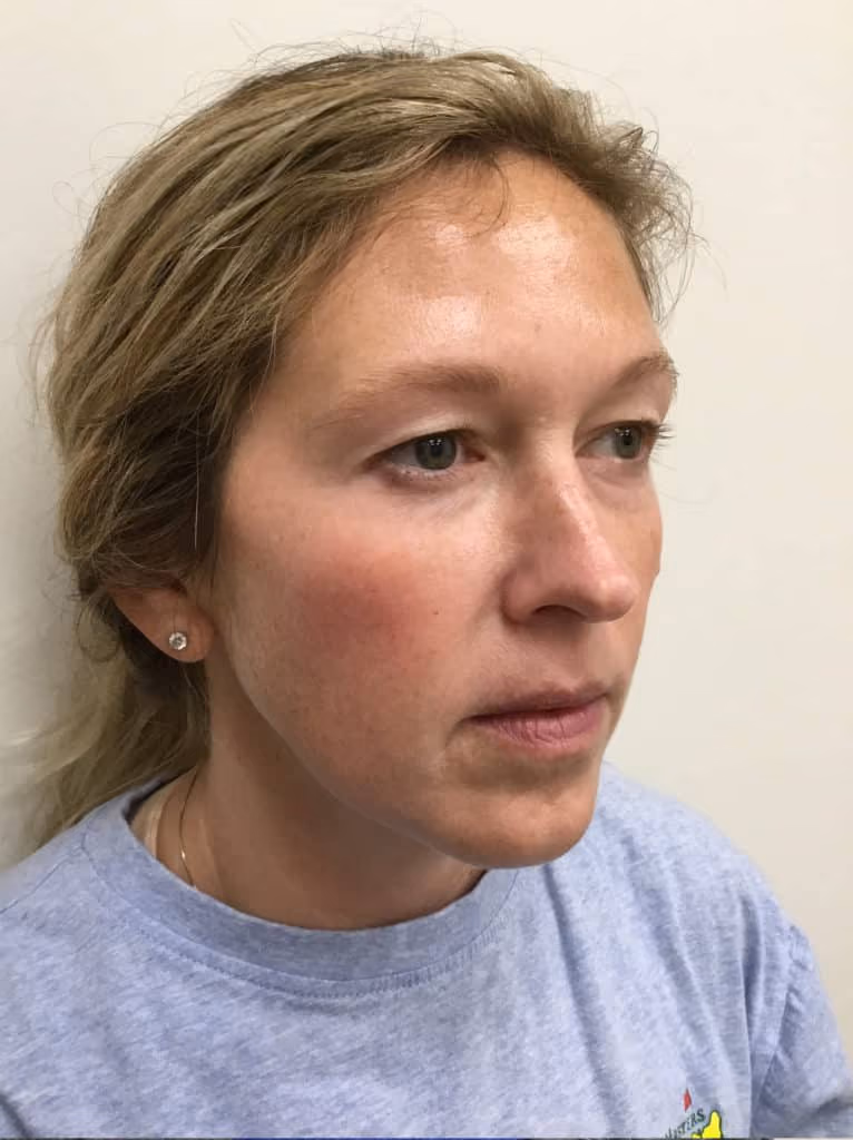 BBL before and after, case 14686 - Cool Springs Plastic Surgery
