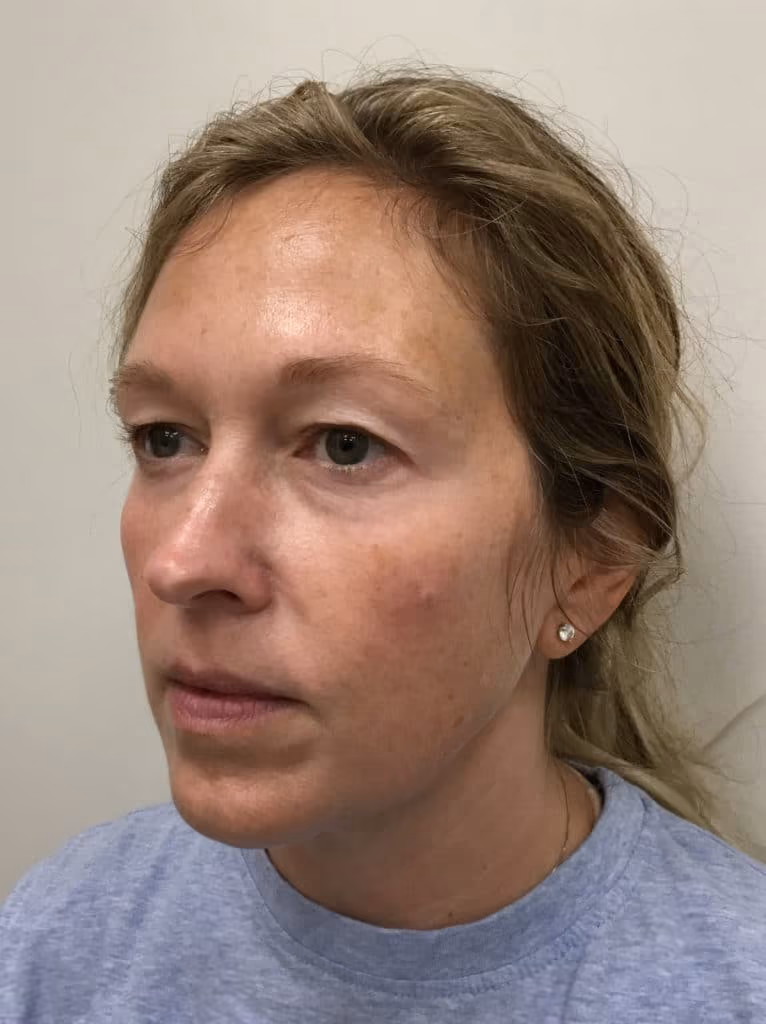 BBL before and after, case 14686 - Cool Springs Plastic Surgery