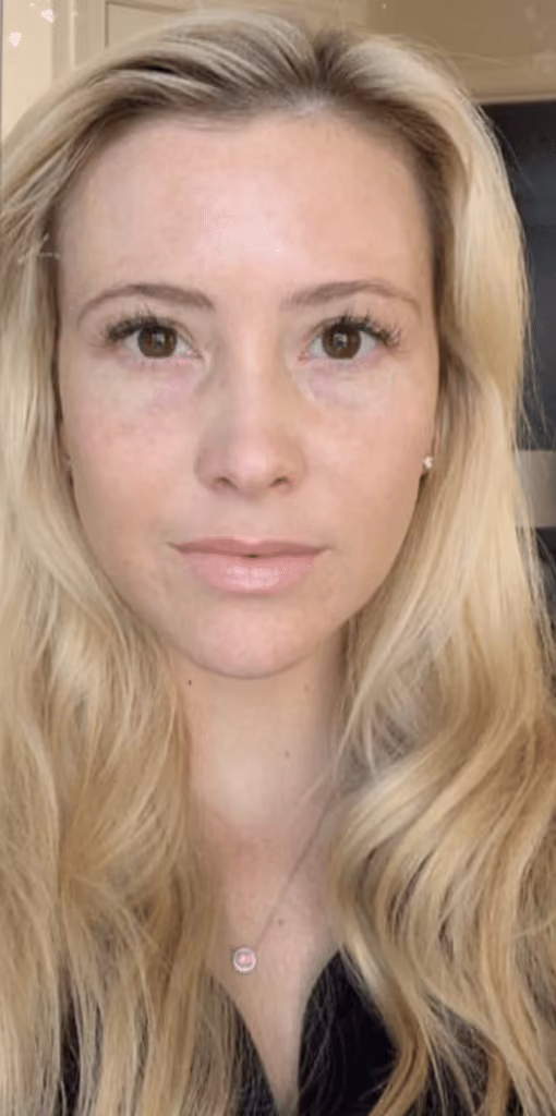 Halo before and after, case 15498 - Cool Springs Plastic Surgery